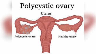 PCOD की समस्या के बारे में वो सबकुछ, जो आपको पता होना चाहिए