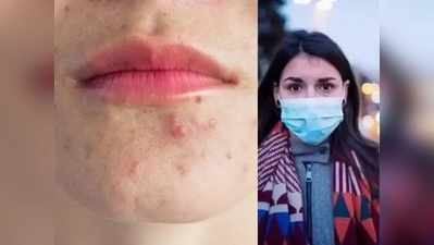 Skin Care Covid 19 : मास्‍कमुळे होतेय मुरुम आणि त्वचा विकारांची समस्या? या ५ टिप्सची घ्या मदत