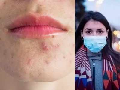 Skin Care Covid 19 : मास्‍कमुळे होतेय मुरुम आणि त्वचा विकारांची समस्या? या ५ टिप्सची घ्या मदत