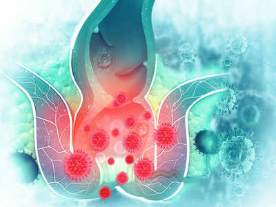 Bowel cancer: आंत में कैंसर होने के शुरुआती लक्षण
