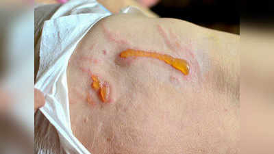 Gangrene: सड़ जाते हैं शरीर के इन हिस्सों के टिश्यू और हो जाता है गैंग्रीन