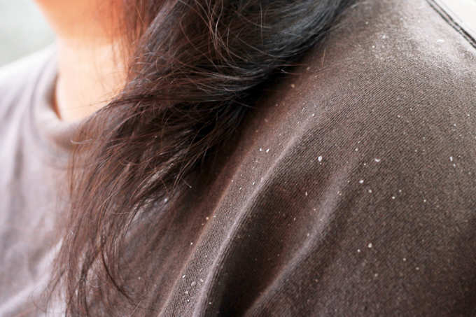 dandruff in women