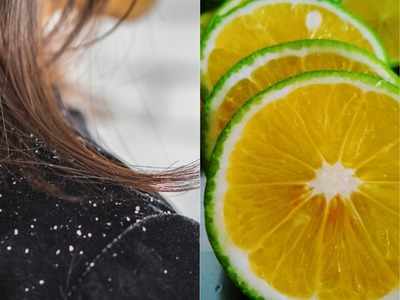 Home Remedies: डैंड्रफ की समस्या हो तो बालों में इन 3 तरीकों से लगाएं नींबू