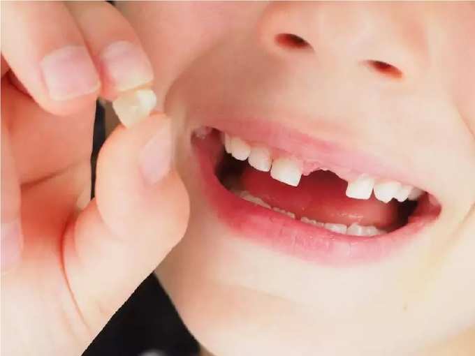 ​दांतों में कीड़ा लगने से क्या उपाय करें