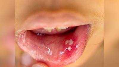 How To Cure Mouth Ulcer : मुंह के छालों को ठीक करने के लिए अपनाएं ये घरेलू उपचार