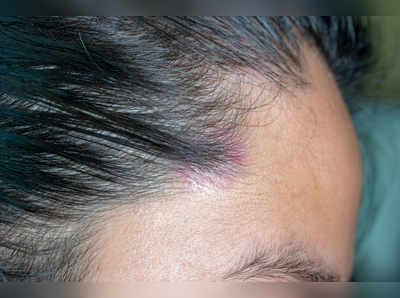 Pimples on Scalp: सिर में होने वाले मुंहासे और फुंसियों का ऐसे करें इलाज, दोबारा नहीं होगी तकलीफ