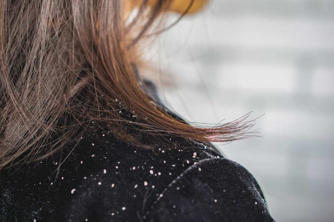 Woman hair with dandruff falling