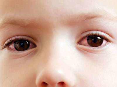 आरोग्यमंत्र: पावसाळ्यात जपा डोळ्यांचे आरोग्य