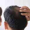 Hair fall early symptoms prevention tips in hindi  बल झडन क लकषण करण  और उपचर  TheHealthSitecom हद