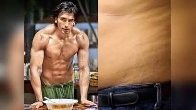 Stretch Marks in Men: करें ये उपाय तो स्किन से जल्दी गायब हो जाएंगे स्ट्रेच मार्क्स