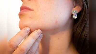 Acne Skin: स्‍किन पर मुंहासे हैं तो न करें ये 6 गलतियां, नहीं तो चेहरा हो जाएगा और खराब