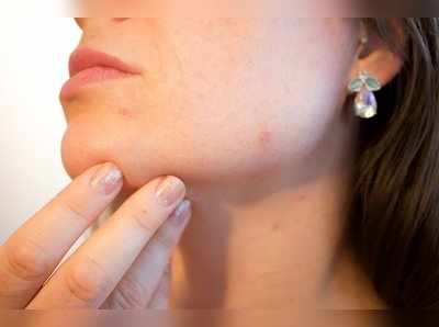 Acne Skin: स्‍किन पर मुंहासे हैं तो न करें ये 6 गलतियां, नहीं तो चेहरा हो जाएगा और खराब