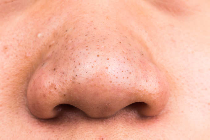 blackheads on nose