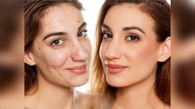 Makeup से ऐसे छिपाएं मुंहासे के दाग धब्बे, खिला खिला नजर आएगा चेहरा