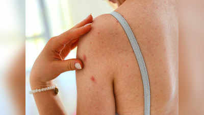 Back Acne Reason: त्वचा पर ऐक्टिव बैक्टीरिया से होते हैं पीठ पर दाने, जानिए दूर करने के घरेलू तरीके