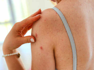 Back Acne Reason: त्वचा पर ऐक्टिव बैक्टीरिया से होते हैं पीठ पर दाने, जानिए दूर करने के घरेलू तरीके