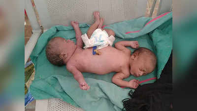 दो मुंह, चार हाथ और दो पैर वाले बच्चे ने लिया जन्म, अस्पताल ने फ्री में शुरू किया इलाज