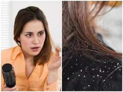 Dandruff Symptoms : பொடுகு வரப்போவதை உணர்த்தும் முக்கிய அறிகுறிகள்,பெண்கள் ஆண்கள் இருவருக்கும்!