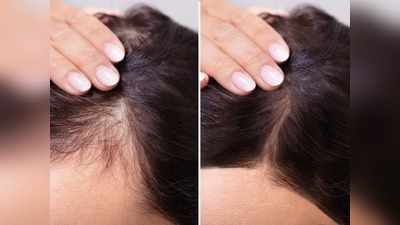 क्‍या सिर पर दिखने लगी है खाली जगह, तो इन 5 Hair Masks से दोबारा उगाएं बाल