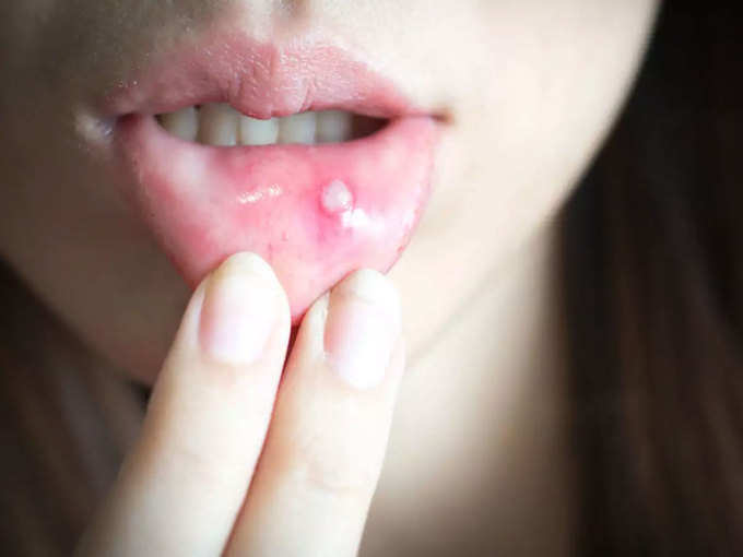 mouth-ulcer-1