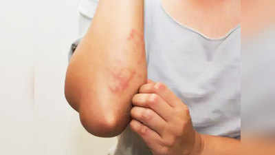 Skin Infection Prevention: आप जरूर जान लें चर्म रोग के मुख्य कारण और बचाव के तरीके