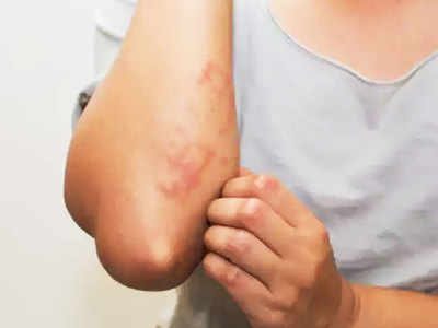 Skin Infection Prevention: आप जरूर जान लें चर्म रोग के मुख्य कारण और बचाव के तरीके
