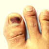 നഖത്തിലെ നിറവ്യത്യാസവും രോഗസൂചനകളും | Nail Abnormalities | Fingernail  Problems