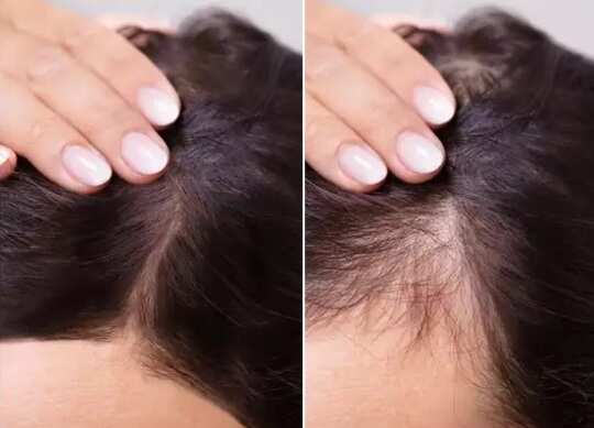 early symptoms of hair loss, Hair Fall Symptoms :முடி கொட்ற பிரச்சனை தீவிரமா இருக்கு என்பதை எப்படி கண்டுபிடிப்பது? அதுக்கு தீர்வு என்ன? - common causes and symptoms for hair fall ... early symptoms of hair loss, Hair Fall Symptoms :முடி கொட்ற பிரச்சனை தீவிரமா இருக்கு என்பதை எப்படி கண்டுபிடிப்பது? அதுக்கு தீர்வு என்ன? - common causes and symptoms for hair fall ...