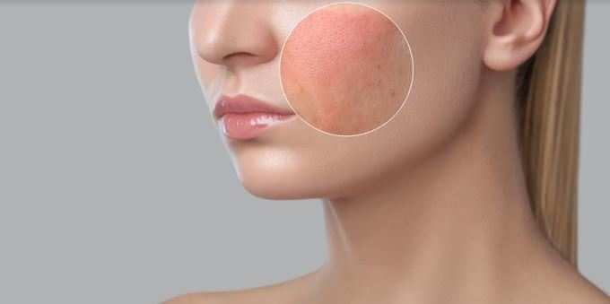 একনে (Acne)