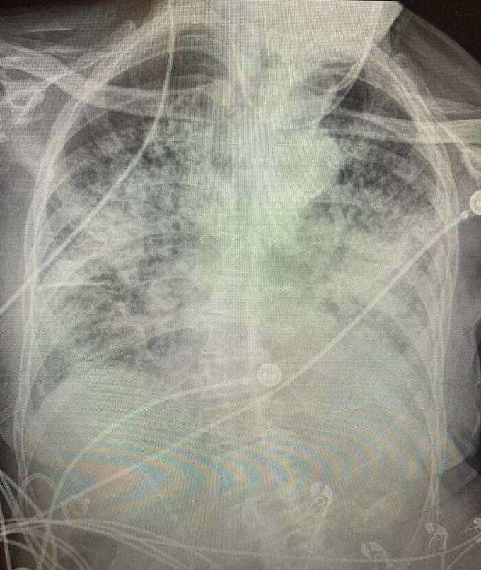 chest x-ray