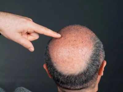 मिल गया गंजेपन का इलाज? वैज्ञानिकों ने सिर पर फिर से बाल उगाने की दवा बनाई!