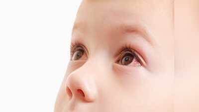 बच्‍चे की लाल हो गई आंख, घबराने की जगह इन घरेलू नुस्‍खों से करें कंजक्टिवाइटिस का इलाज