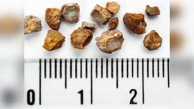 Kidney Stone: पथरी के मरीज हैं तो, क्‍या खाएं और किन चीजों से करें परहेज