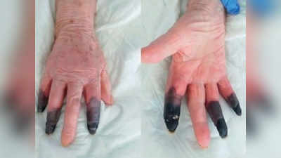 COVID-19 ने बनाया गैंगरीन तो काला पड़ा हाथ, काटनी पड़ीं महिला की तीन उंगलियां