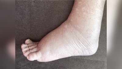 Swollen feet: पैर और घुटनों की सूजन को हल्‍के में लेने की न करें भूल, हो सकती है यह गंभीर बीमारी
