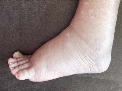 Swollen feet: पैर और घुटनों की सूजन को हल्‍के में लेने की न करें भूल, हो सकती है यह गंभीर बीमारी