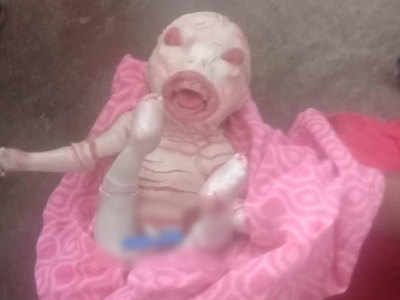 Bihar News: एलियन जैसे दिखने वाले बच्चे का जन्म, देखने के लिए उमड़ी भीड़, डॉक्टर बोले- 10 लाख में एक आता है ऐसा मामला