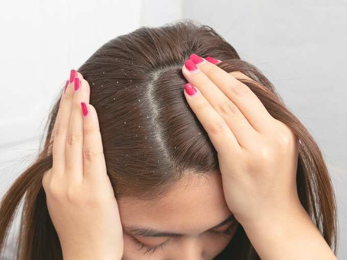 close-up-hair-at-the-dandruff-on-brown-female-hair-picture-id1204365090