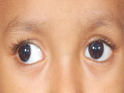 Rare Surgery: दोनों आंखों में जन्मजात मोतियाबंद था, 11 महीने के बच्चे की सर्जरी कर लौटाई रोशनी