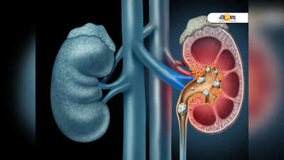 World Kidney Day 2021: কিডনিতে পাথর জমছে কি? কোন কোন লক্ষণ দেখা দিলে সতর্ক হবেন, জানুন...