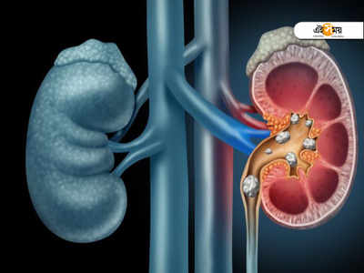 World Kidney Day 2021: কিডনিতে পাথর জমছে কি? কোন কোন লক্ষণ দেখা দিলে সতর্ক হবেন, জানুন...