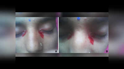पीरियड्स में महिला की आंख से निकले खून के आंसू, दुर्लभ से दुर्लभतम केस से डॉक्टर हैरान