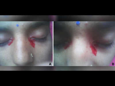 पीरियड्स में महिला की आंख से निकले खून के आंसू, दुर्लभ से दुर्लभतम केस से डॉक्टर हैरान