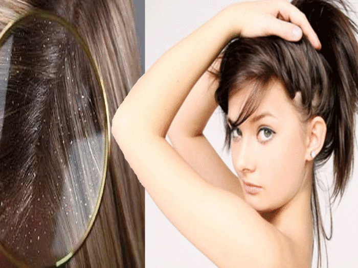 summer hair care dandruff control tips clean oil free hair at home