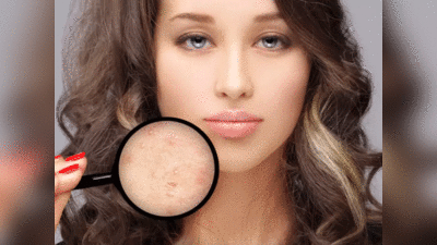 Pimple Removing Tips: रातभर में गायब हो जाएगा पिंपल, सोने से पहले करें इन 5 में से कोई 1 उपाय