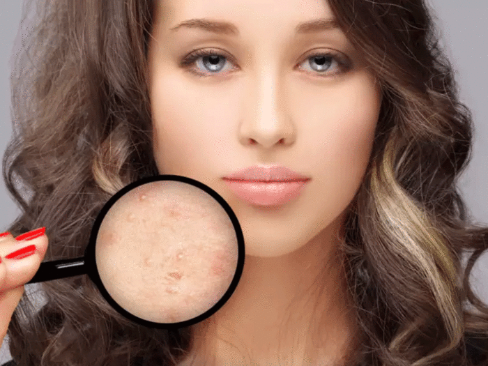 skin care home remedies to remove pimple overnight