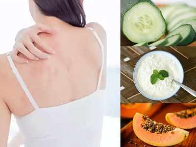 Summer Skin Care घामोळ्याच्या समस्येमुळे आहात त्रस्त? त्वचेची होणारी जळजळ कमी करण्यासाठी करा हे ५ सोपे उपाय