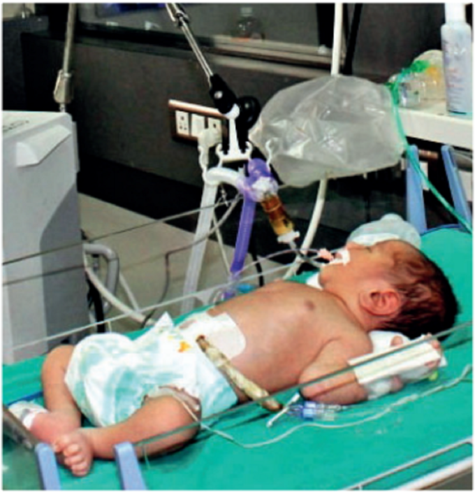 surat infant