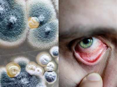 Black Fungus: नहीं निकलवानी पड़ेगी आंख, अगर पहचान लेंगे ब्‍लैक फंगस के ये 5 खतरनाक लक्षण