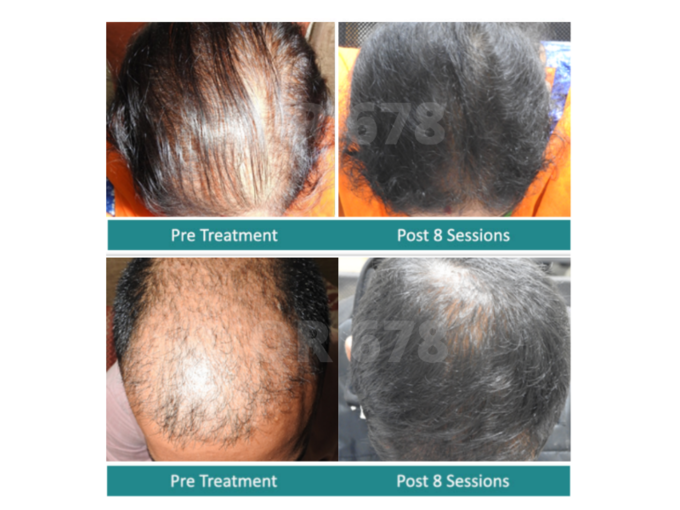 Best hair treatment in Mumbai, India for hair loss, fall in men and women by QR678, The Esthetic Clinics